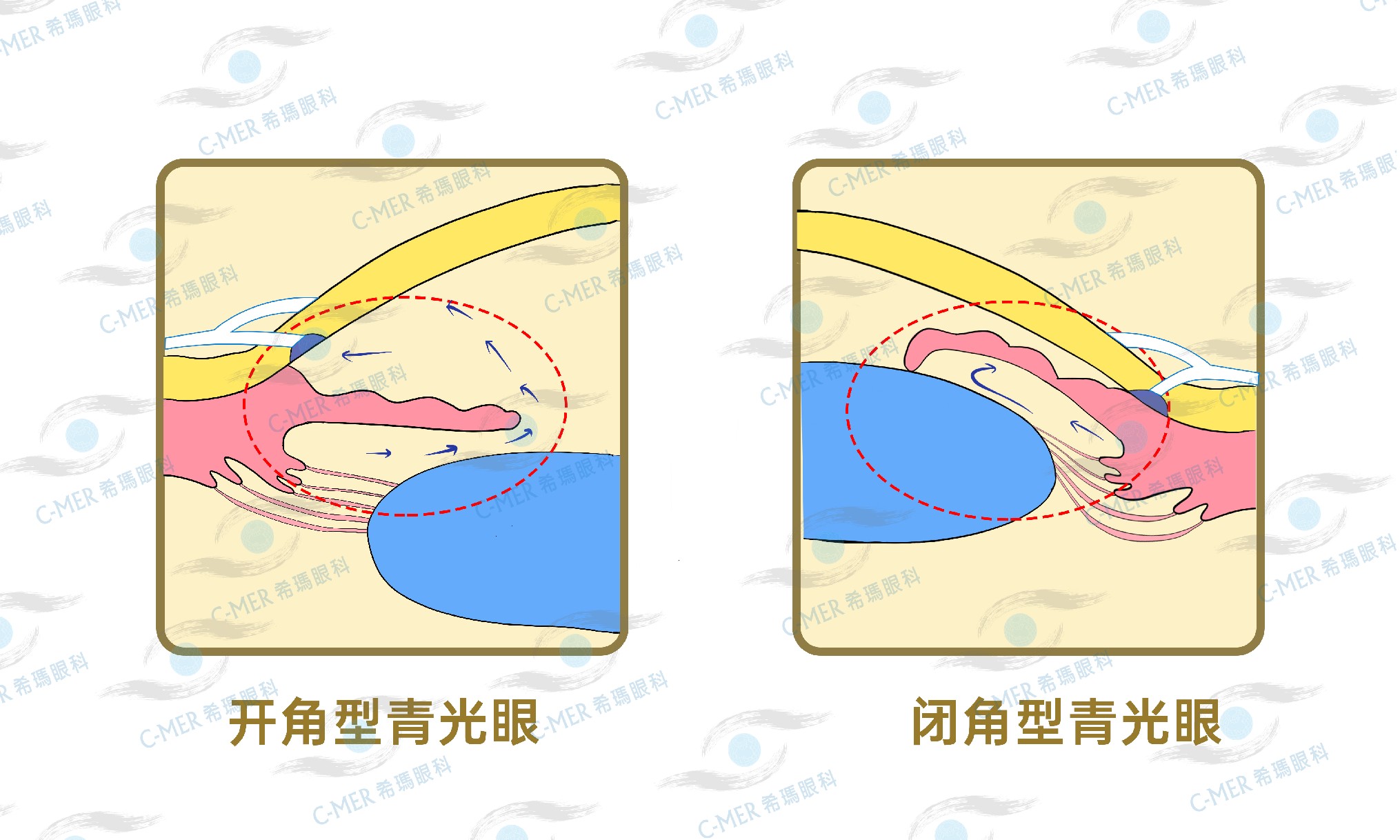 一天八杯水，小心引發(fā)致盲性眼??！