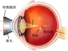 惠州眼科醫(yī)院：“蚊子”飛進眼睛里會瞎？