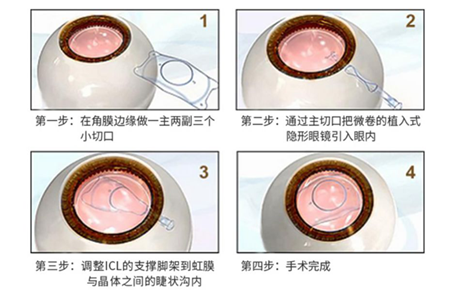 下半年,征兵,報(bào)名,開始,啦,近視,能,參軍,嗎,