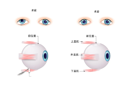 斜視,兒童斜視,斜視治療,斜視矯正,斜視手術