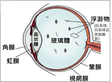 近視,高度近視,飛蚊癥,飛蚊治療