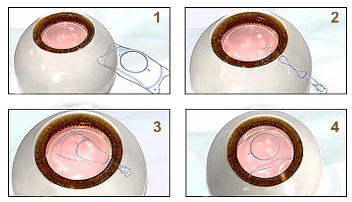 近視,近視手術(shù),近視矯正,激光近視手術(shù),全飛秒,icl