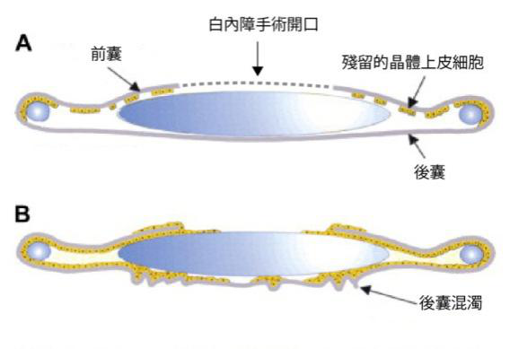 白內(nèi)障手術(shù)