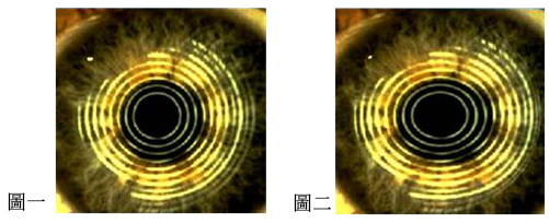 正常與散光的瞳孔