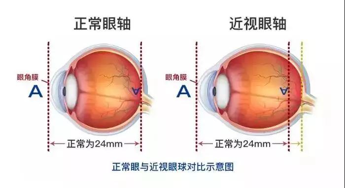 近視,小兒眼病,惠州?，斞劭漆t(yī)院