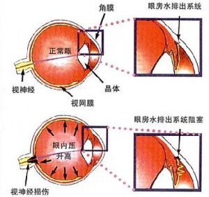 青光眼危害