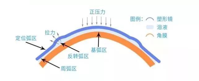 青少年近視,兒童近視,OK鏡,惠州希瑪眼科醫(yī)院