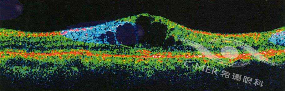 黃斑水腫,治療,希瑪,眼科,病癥,糖尿病,黃斑,林順