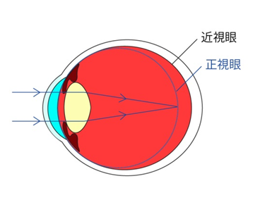 高度近視,屈光,近視,惠州希瑪眼科