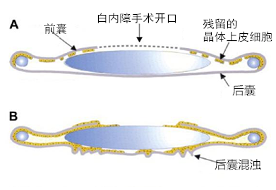 白內(nèi)障,人力,出現(xiàn),白內(nèi)障手術(shù),手術(shù)治療