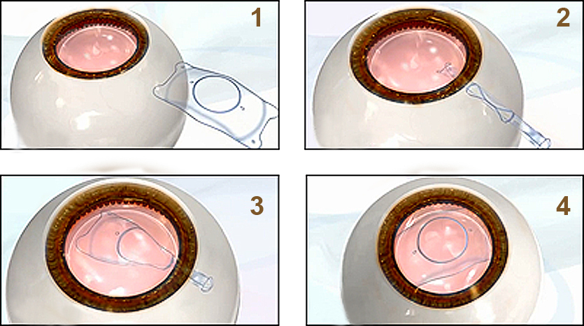 全飛秒激光近視手術(shù),半飛秒激光近視手術(shù),惠州希