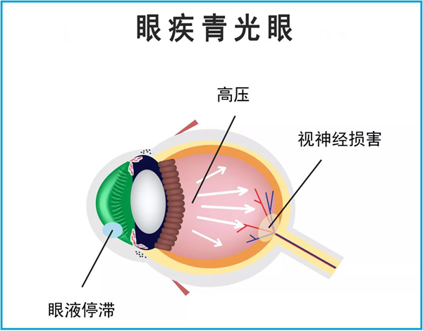 青光眼,繼發(fā)型青光眼,惠州希瑪眼科醫(yī)院