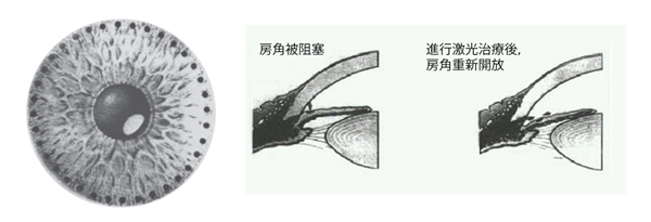 白內(nèi)障,白內(nèi)障手術,惠州?，斞劭漆t(yī)院