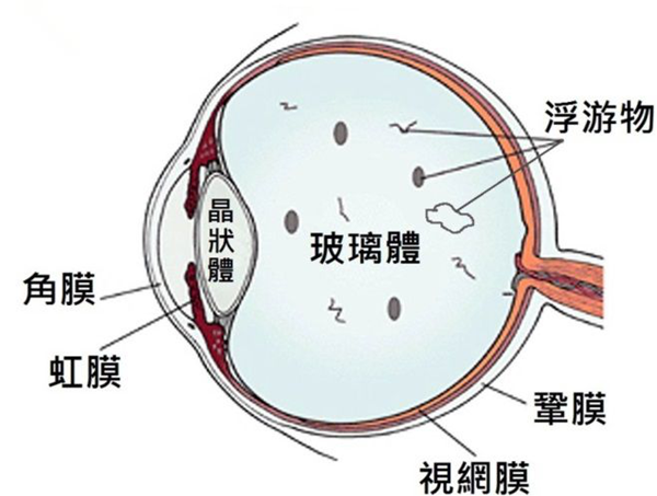 飛蚊癥,玻璃體渾濁,飛蚊癥治療,惠州?，斞劭漆t(yī)院