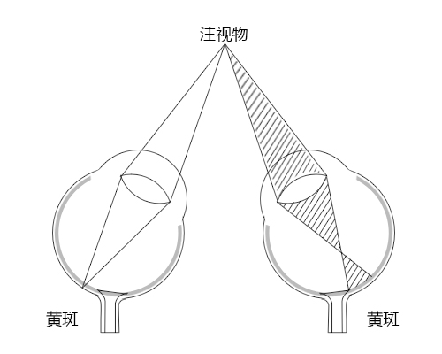 弱視,小兒弱視,治療弱視,惠州希瑪眼科醫(yī)院