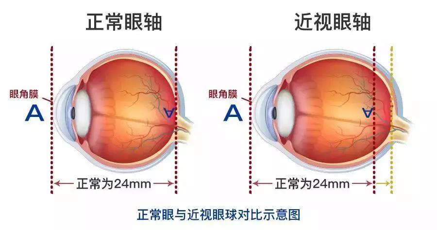 近視,惠州治療近視哪家好,惠州?，斄猪槼毖劭漆t(yī)院