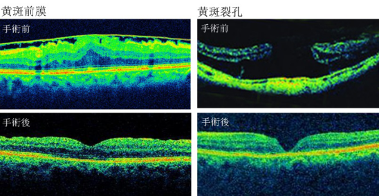 近視,惠州治療近視哪家好,惠州?，斄猪槼毖劭漆t(yī)院