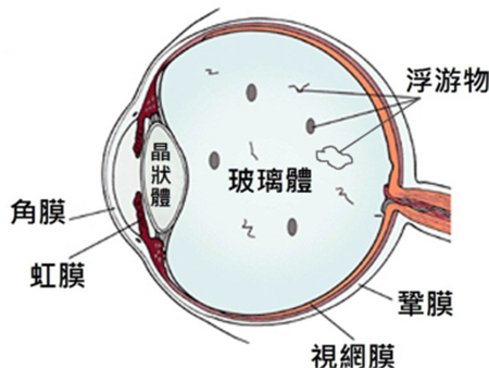 飛蚊癥是什么原因引起的