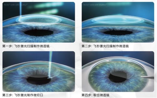 飛秒激光和準分子激光的區(qū)別